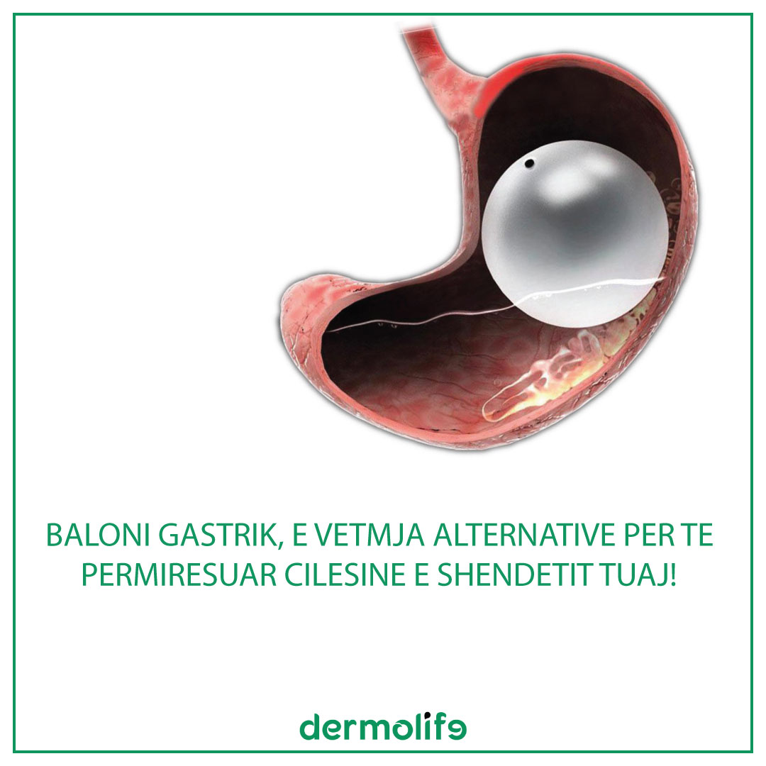 Permireso Shendetit me Balonin Gastrik